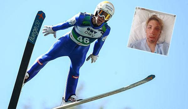 Ski Jumping: After Fall: Diethart posts shock photo